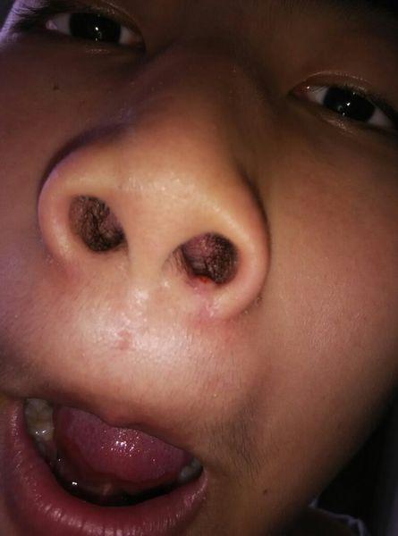 我的鼻子里长了一个小痘痘,请问是什么病