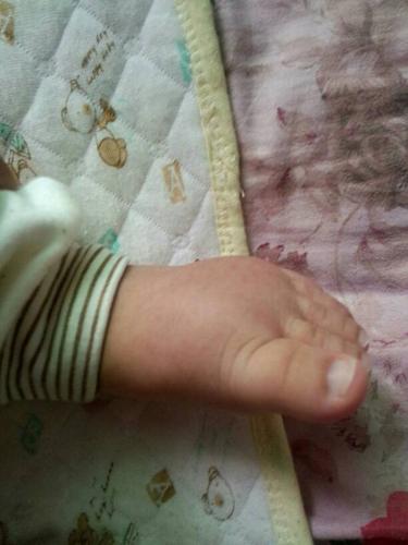 有没有三个月的宝宝脚这样子的,是婴儿肥,还是肿呢?下面附图
