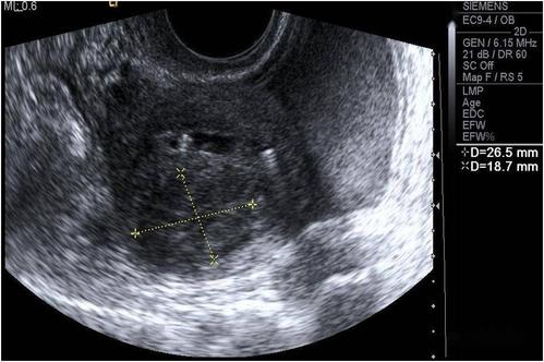 超声典型病例:子宫穿孔