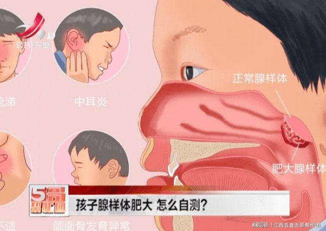 孩子腺样体肥大 怎么自测?