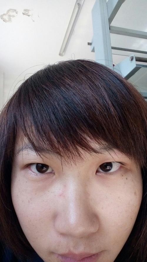 戴眼镜眼睛变形了,有点下凹,割双眼皮会不会和你难看