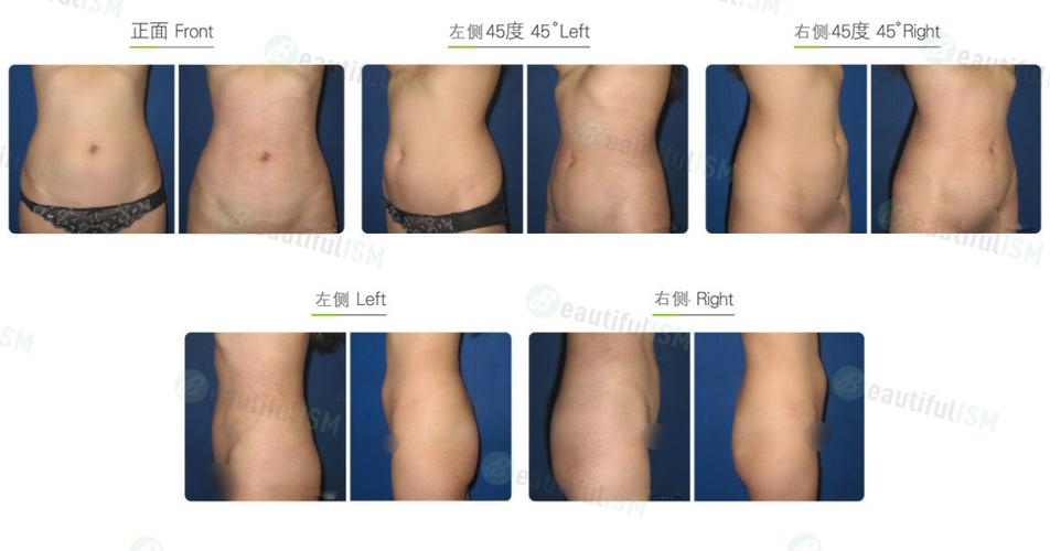 腰腹吸脂-后腰(女)效果图,案例前后对比照片