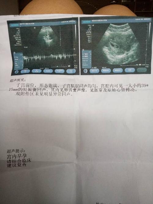 怀孕50天孕囊39*15mm 是男孩是女孩2胎