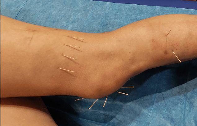 接诊之后,周医师以"横针"施治,所谓横针,即在传统针灸的基础上改良