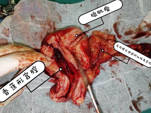 "一箭双雕"——南人医妇科 腹腔镜下切除残角子宫及单角子宫