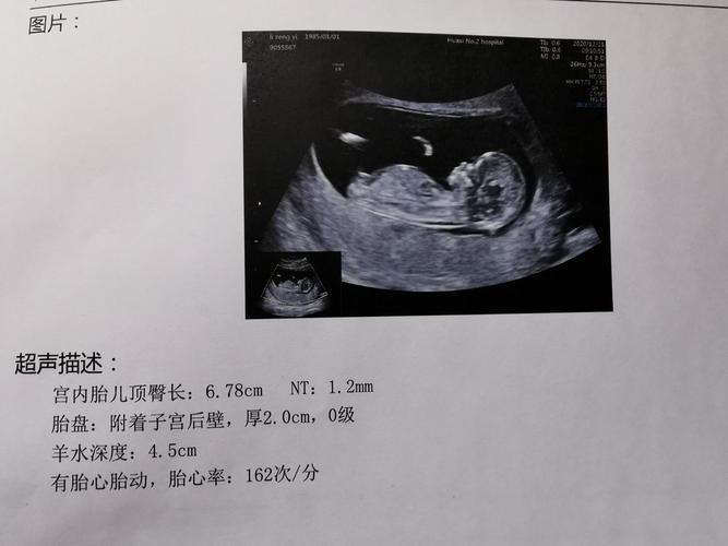 [试管婴儿]真是妈妈的好大儿,nt秒过,看