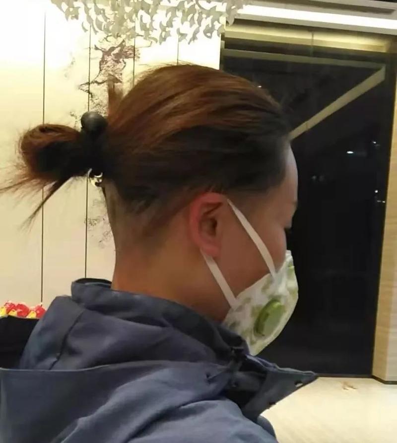 护士徐珊后脑勺的头发剃光了