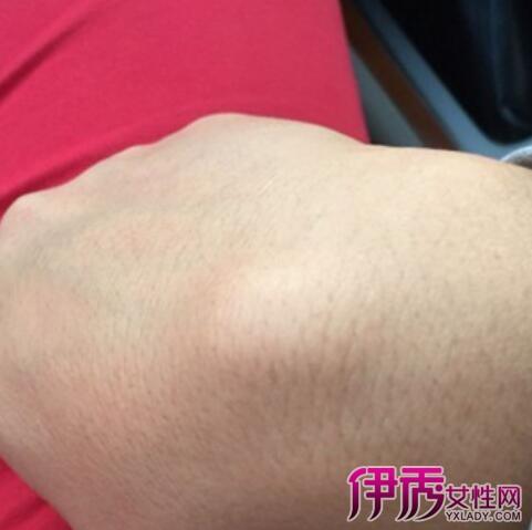 手腕腱鞘囊肿最佳治疗方法 腱鞘囊肿最佳治疗方法