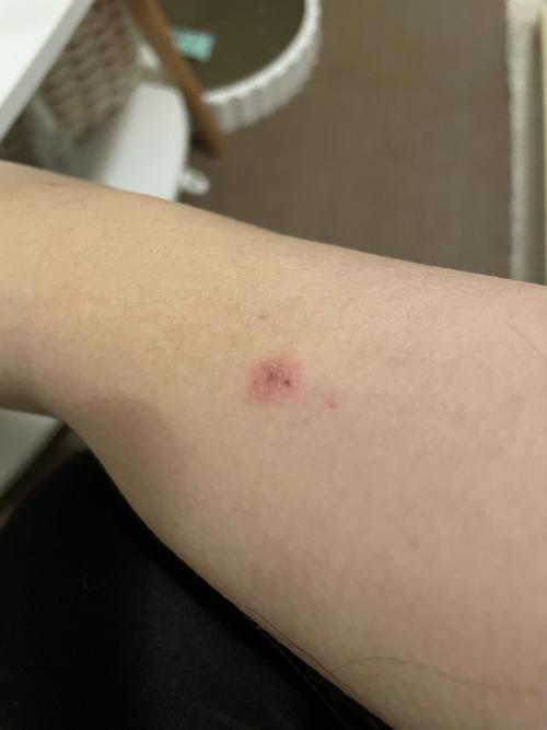 姐妹们这是猫藓吗_猫猫_人得猫藓_医疗健康_医疗健康