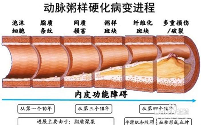 动脉粥样硬化是检查什么的?
