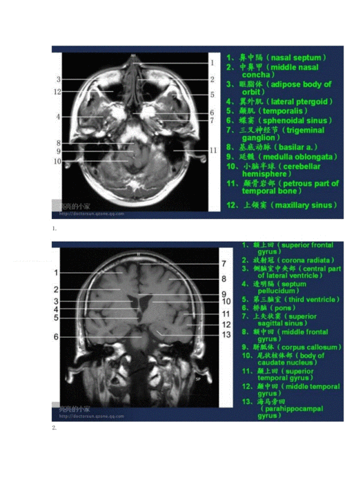 头颅mri(磁共振成像)断层图谱.doc