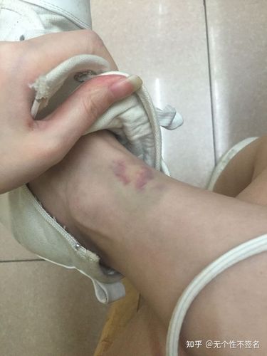 脚上因为血小板低 导致的淤青