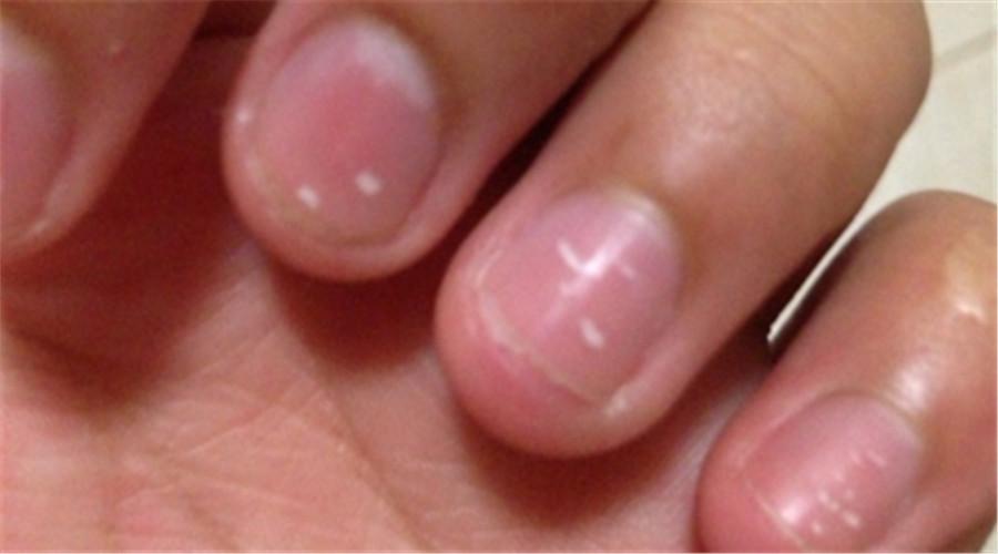 宝宝指甲出现哪些异常时,宝妈妈需要注意