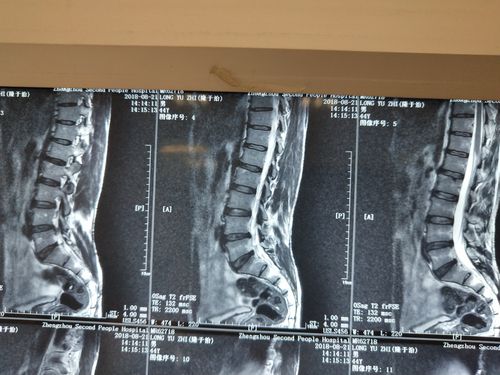 下肢疼痛症状明显,而影像学突出又不十分典型的 腰椎间盘突出症>必须