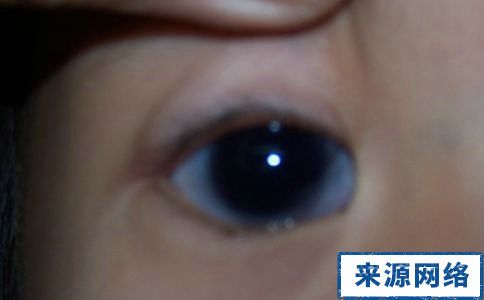 先天性青光眼症状图片
