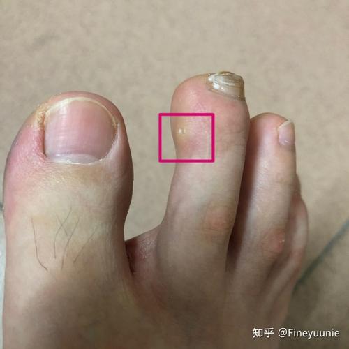 脚趾上长透明疙瘩,中心点像针刺一样的形状