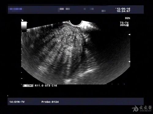 典型病例——子宫腺肌症(一) - 超声医学讨论版 - 医
