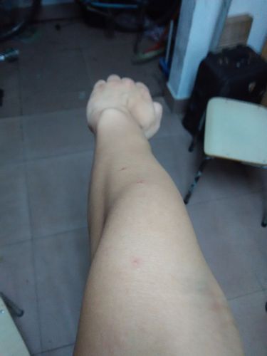 想去当兵,有经验的帮忙看看胳膊,是不是肘外翻?