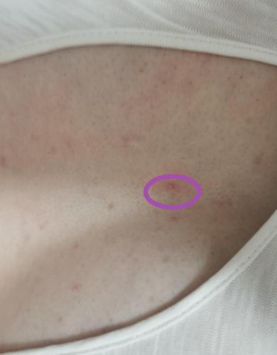 胸口长这种痘痘,你们都是怎么处理