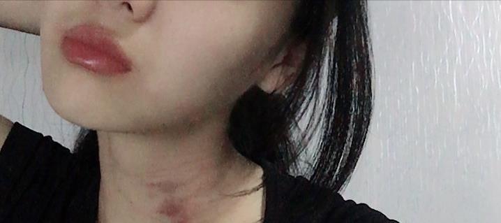 从中可以清楚地看到脖子被掐,手臂以及腿上淤青等各种伤