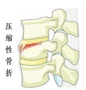 胸腰椎压缩性骨折,一般是指前屈伤力造成椎体前半部(前柱)压缩,脊椎后