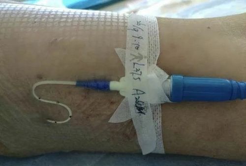 静脉置管(cvc,plcc)自护知识宣教