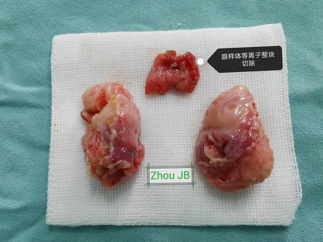 腺样体切除术 - 好大夫在线