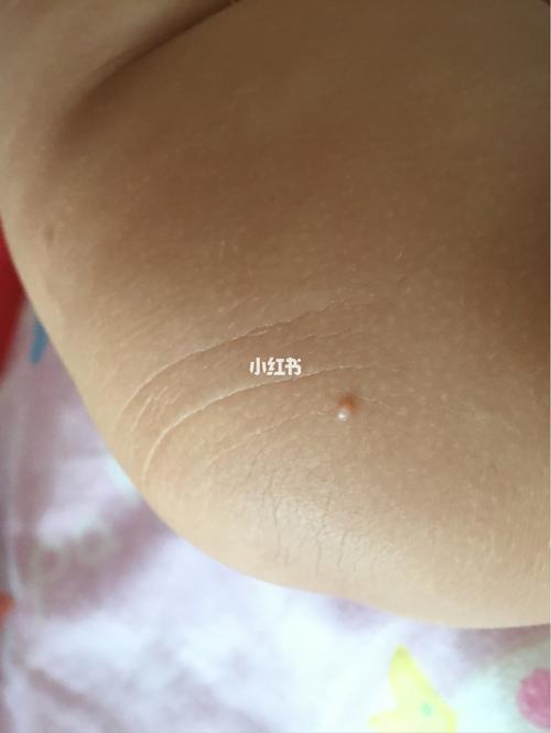 宝宝7个多月了 身上起的这个是脂肪粒嘛 有一段时间了 慢慢的好像大