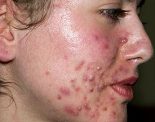 痤疮