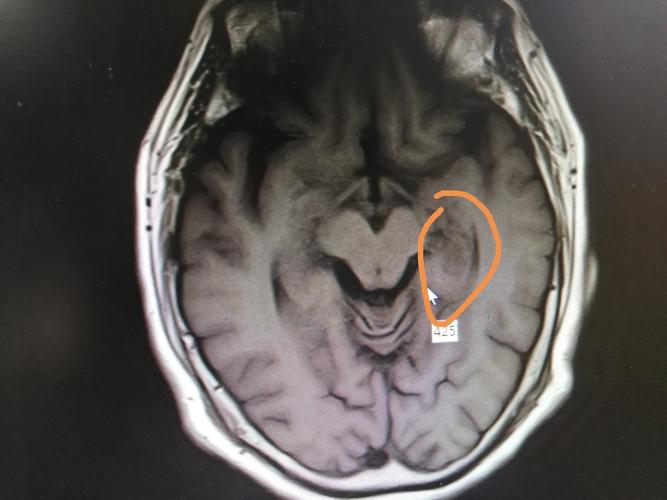 海马磁共振解剖