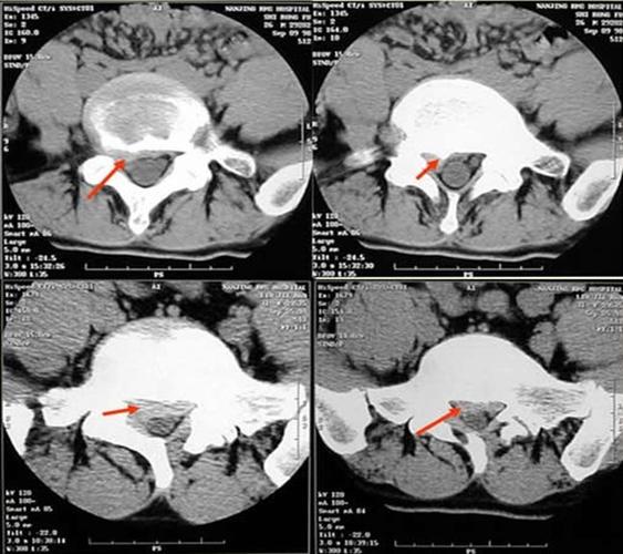 椎间盘突出示意图    轻度膨出时表现为椎间盘后缘正常肾形凹陷
