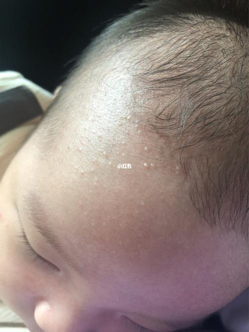 想问下这是新生儿痤疮吗,跟长痘痘一样,宝宝现在50多天,月子的时候还