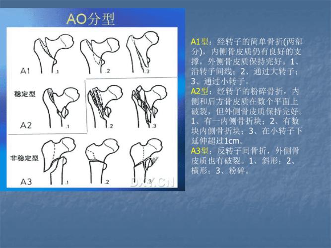 股骨转子间骨折的分型治疗 ppt