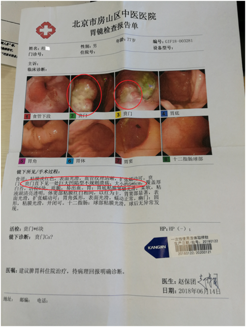 胃癌单纯中医药治疗