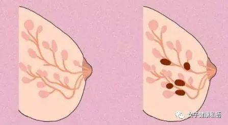 乳腺增生一般不用治,但遇到这2种情况就危险了