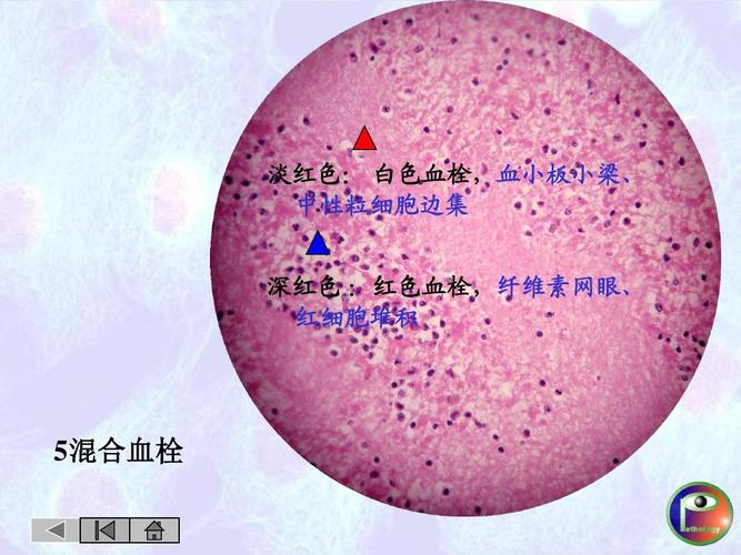 高等教育 医学 病理切片(复习26张)答案ppt  淡红色: 白色血栓,血小板