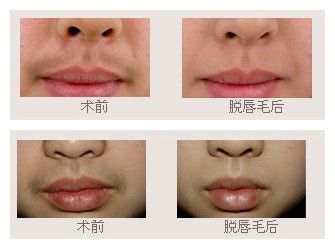 自己的另一半与自己kiss时都不会看到"浓密"的唇毛,为摆脱唇毛历尽千