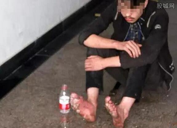 玩网游致双脚腐烂