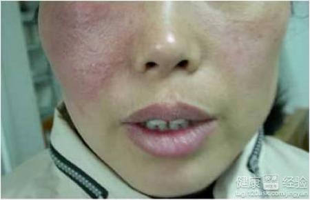 丹毒可以洗澡吗