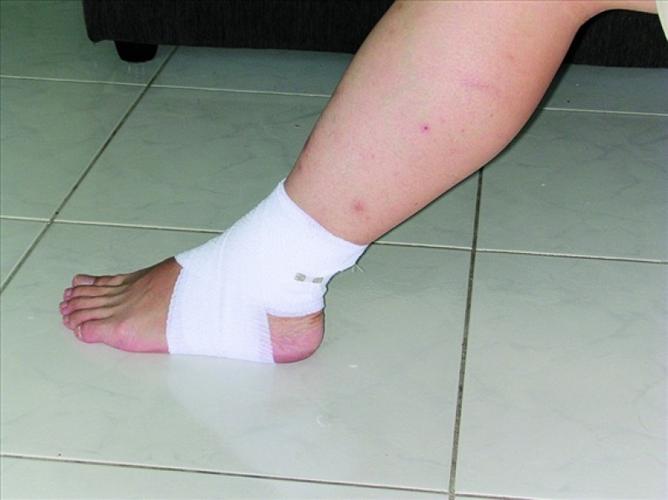 【登山医学】脚踝扭伤怎麼办?