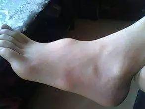脚底板上长了小疙瘩,竟然不用治?