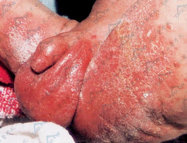 【图】念珠菌感染引起的病变〔慎入〕 - 皮肤病学