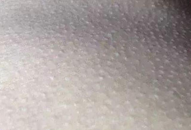 所以也称鸡皮肤,官方名称是毛周角化症