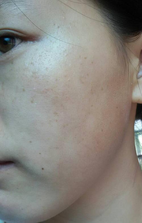 请问这是花斑藓么,俗称的汗斑,应该擦点什么药膏好?