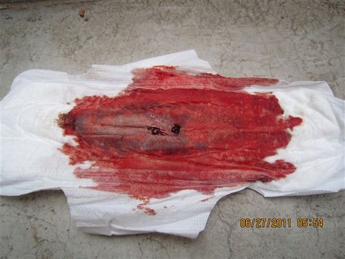 青春期子宫功能性出血,典型病例摘要,一起努力战胜功血!