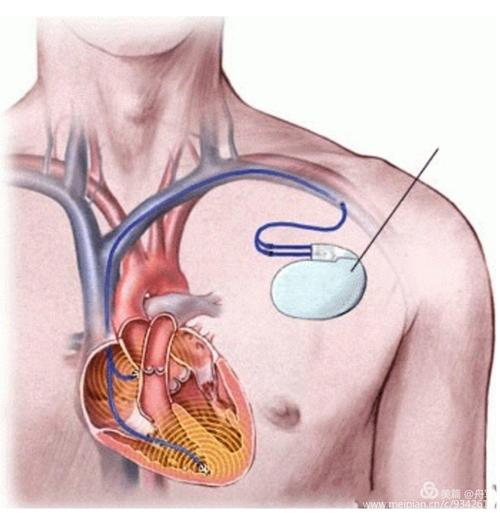 心脏起搏器