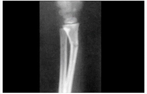 x线检查对骨折的意义主要是