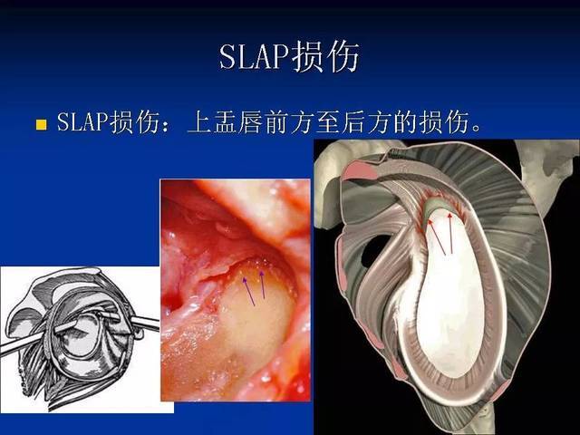 肩关节盂唇损伤的mri诊断 | 影像天地