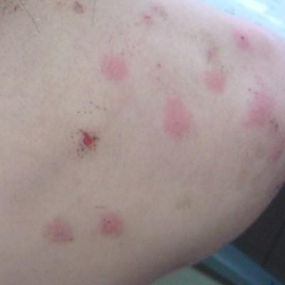 如何鉴别虫咬性皮炎的症状与分型