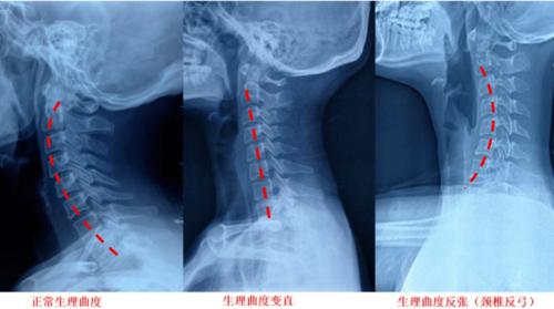 恢复颈椎曲度的方法,你值得珍藏